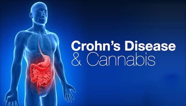 Cannabis as a therapeutic option for Crohn's disease