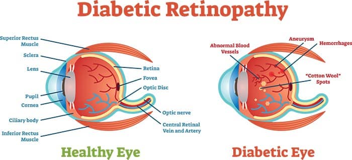 Diagram of Diabetic Retinopathy
